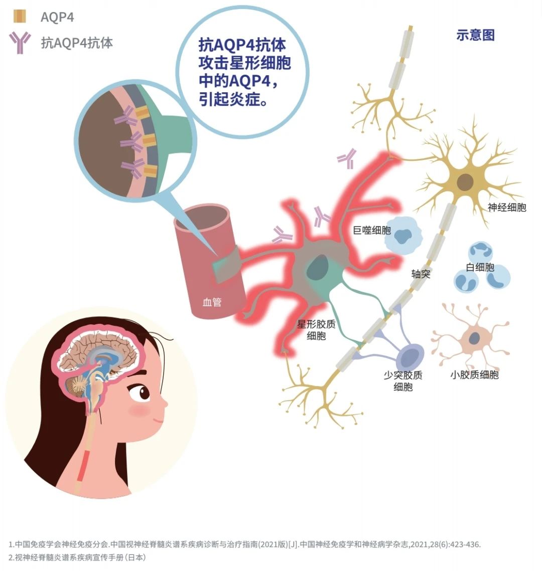 试界医学-视神经脊髓炎谱系疾病(NMOSD)知识手册(上篇)